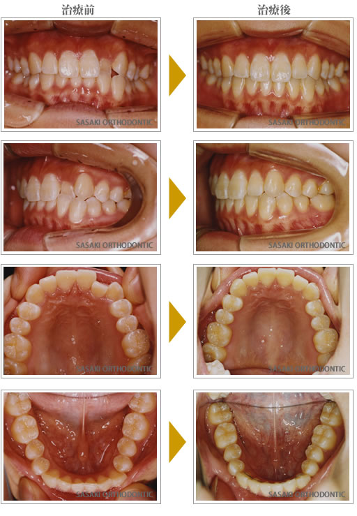 部分矯正上顎前歯の反対咬合症例
