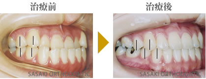 1歯対2歯の関係の確立