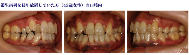 歯並びの悪影響