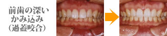 過蓋咬合（前歯の深いかみ込み）治療