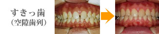 隙歯列（すきっ歯）治療